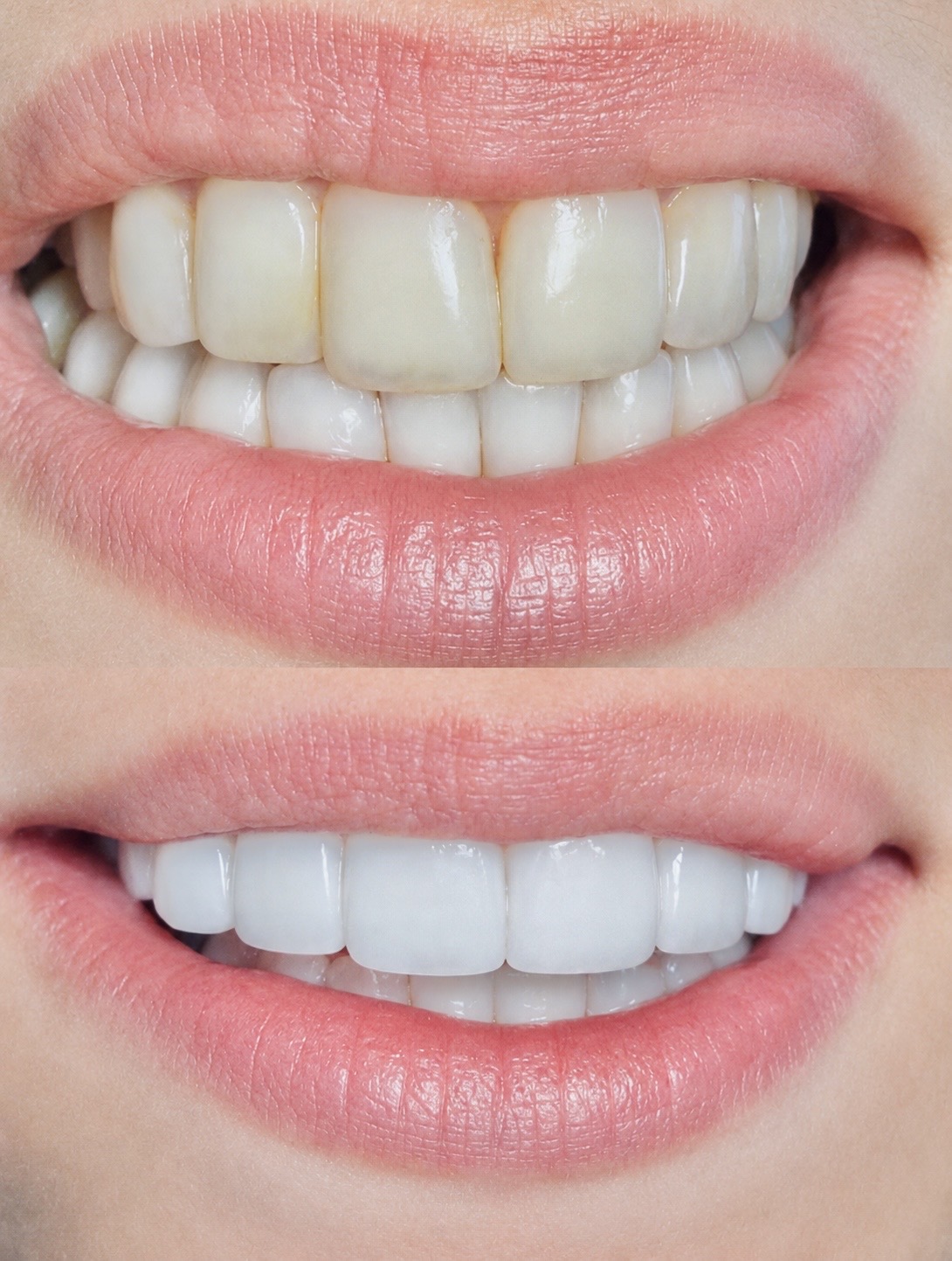 Composite Veneers Case 01