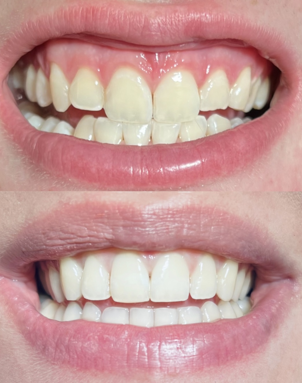 Composite Veneers Case 03