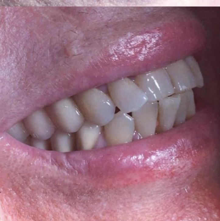 Implants result after treatment