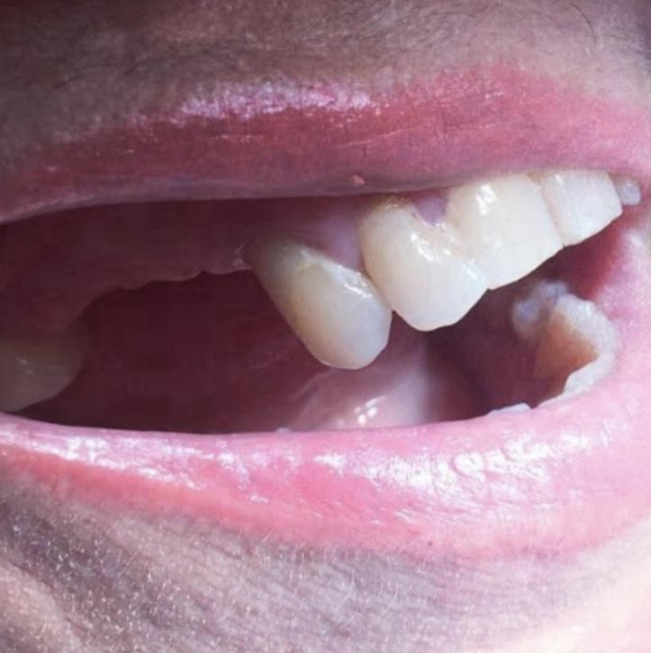 Implants before treatment