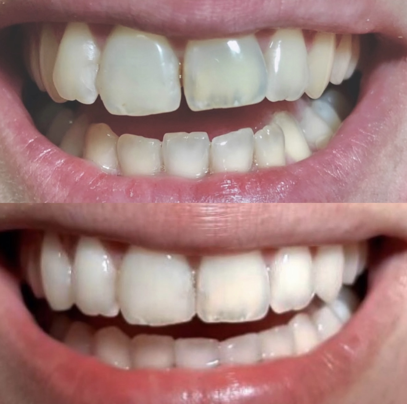 Invisalign Case 01