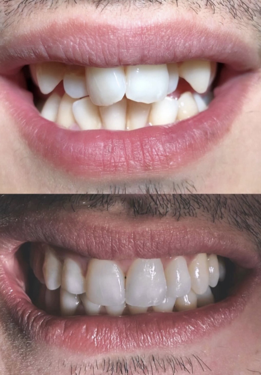Invisalign Case 02