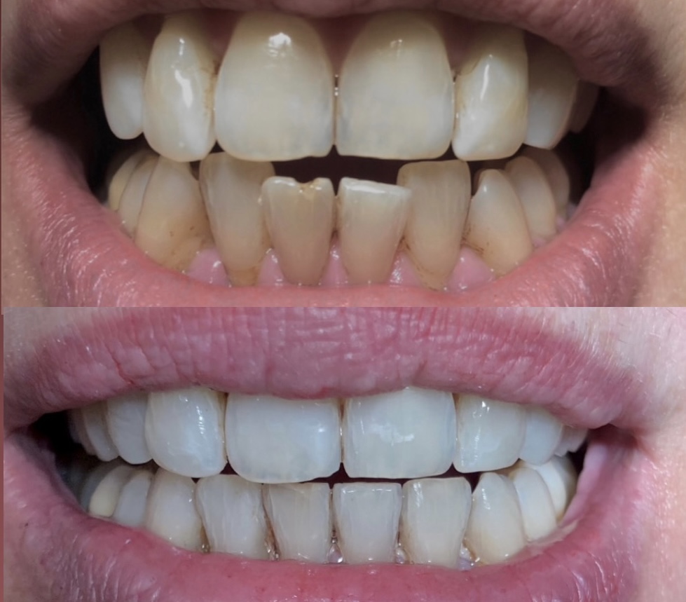 Invisalign Case 03