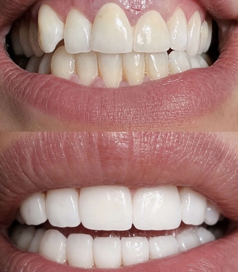 Porcelain Veneers Case 01