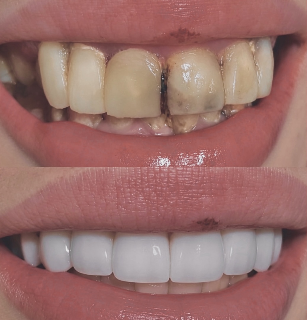 Porcelain Veneers Case 02