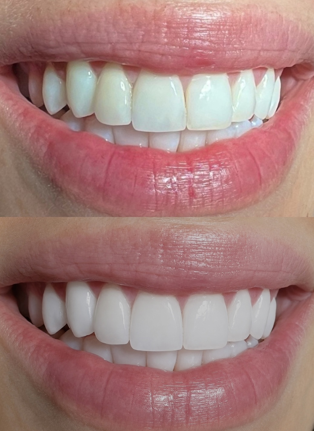 Whitening Case 01
