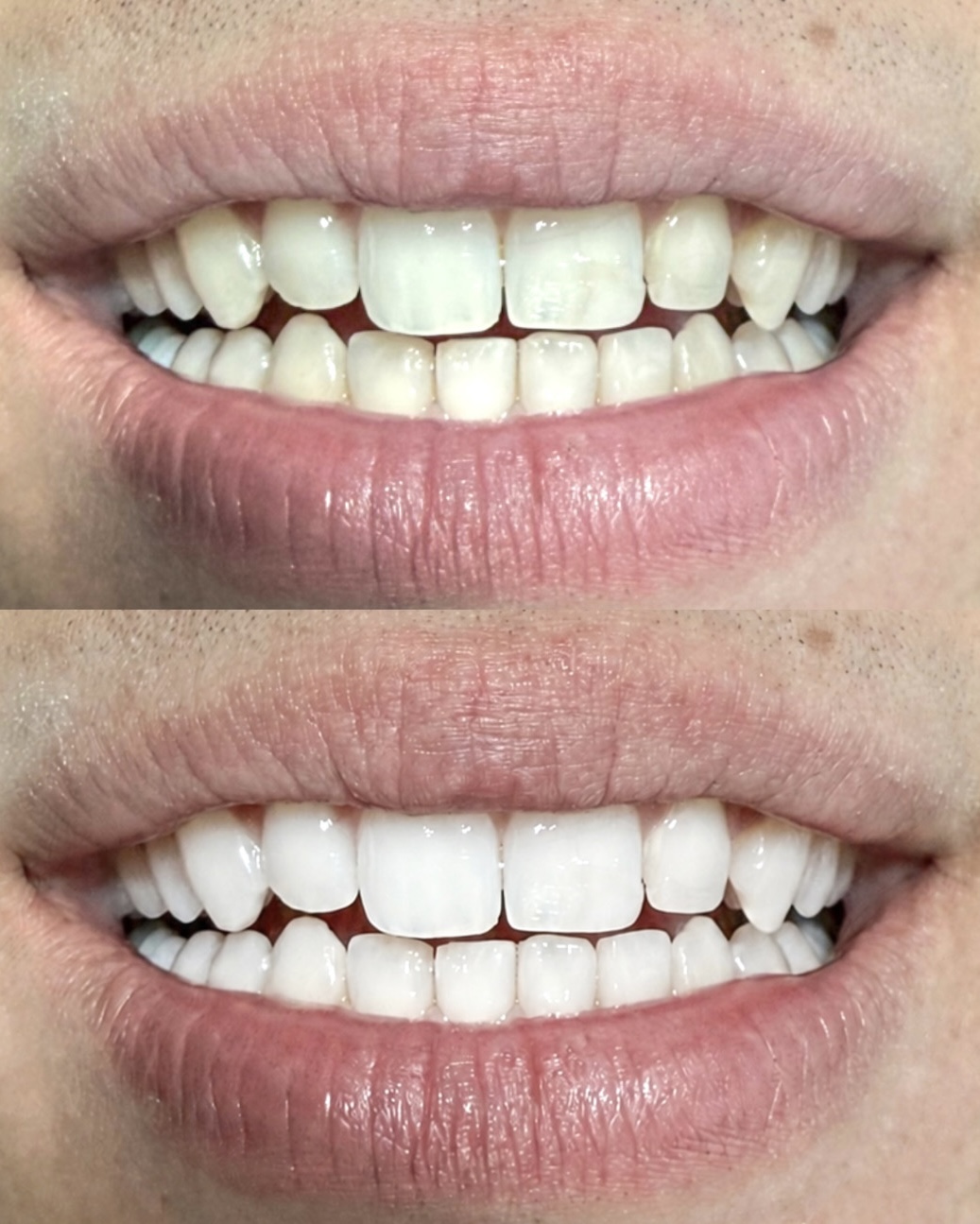 Whitening Case 02